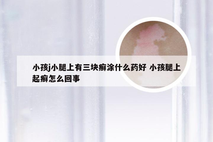 小孩j小腿上有三块癣涂什么药好 小孩腿上起癣怎么回事