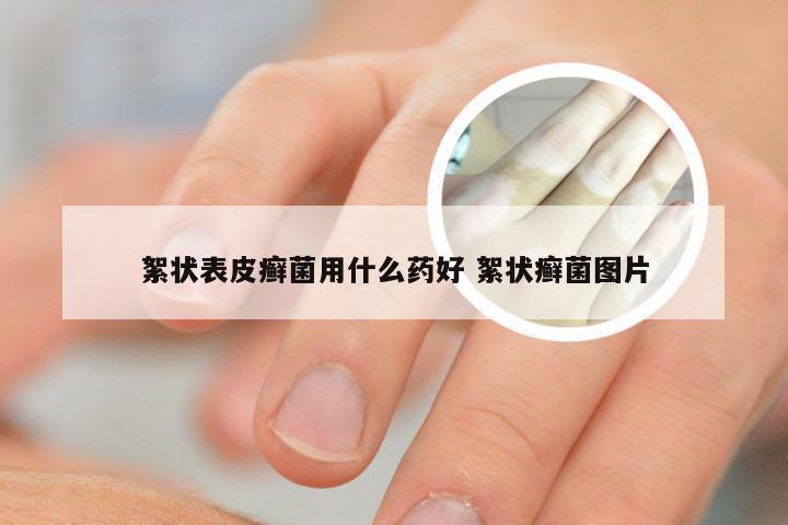 絮状表皮癣菌用什么药好 絮状癣菌图片