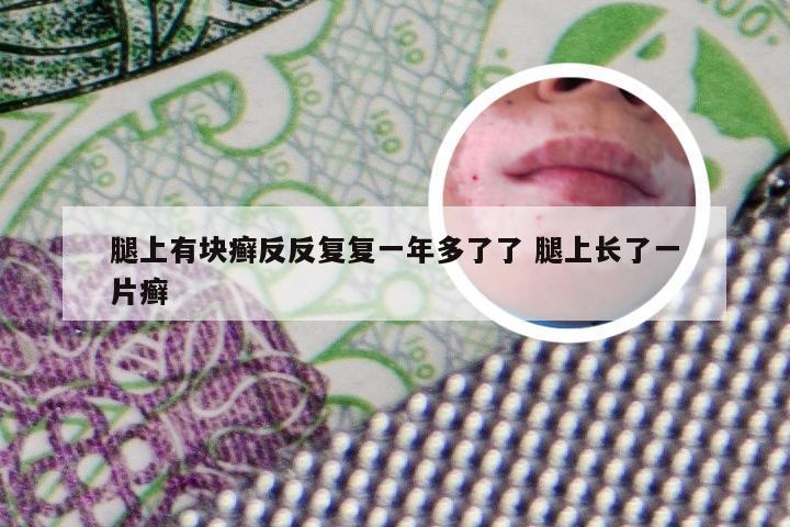 腿上有块癣反反复复一年多了了 腿上长了一片癣