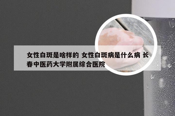 女性白斑是啥样的 女性白斑病是什么病 长春中医药大学附属综合医院