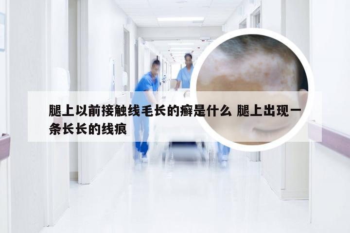 腿上以前接触线毛长的癣是什么 腿上出现一条长长的线痕