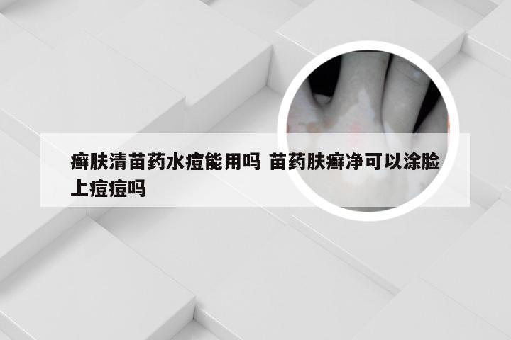 癣肤清苗药水痘能用吗 苗药肤癣净可以涂脸上痘痘吗