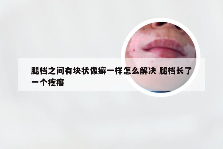 腿档之间有块状像癣一样怎么解决 腿档长了一个疙瘩