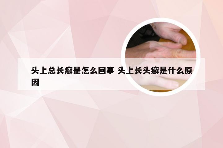 头上总长癣是怎么回事 头上长头癣是什么原因