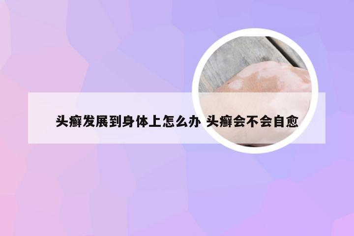 头癣发展到身体上怎么办 头癣会不会自愈