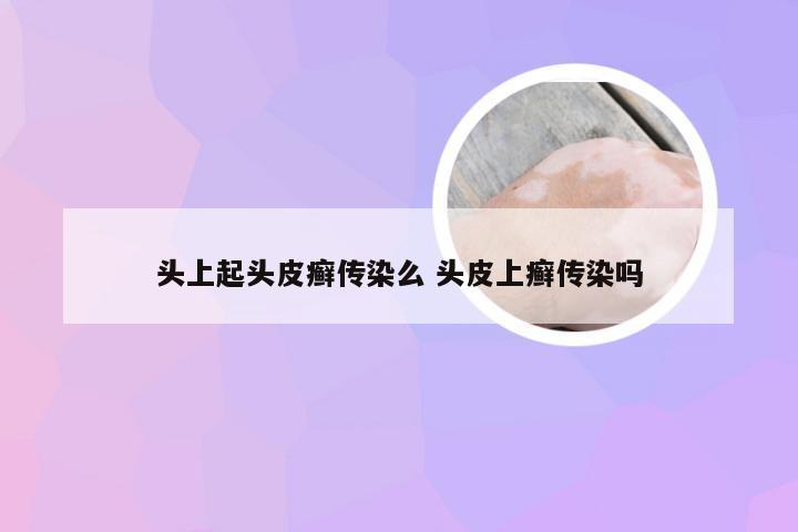 头上起头皮癣传染么 头皮上癣传染吗