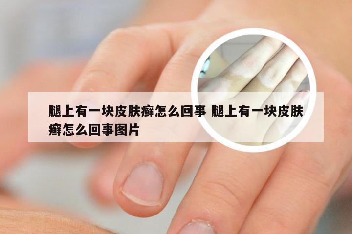 腿上有一块皮肤癣怎么回事 腿上有一块皮肤癣怎么回事图片