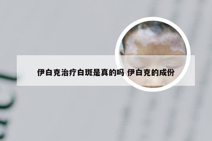 伊白克治疗白斑是真的吗 伊白克的成份