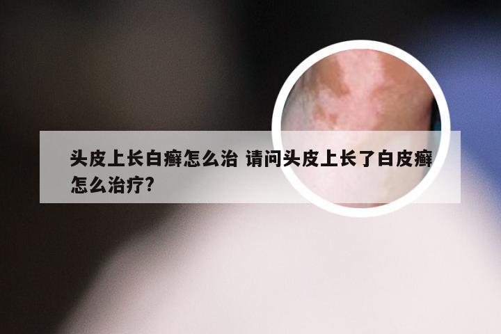 头皮上长白癣怎么治 请问头皮上长了白皮癣怎么治疗?