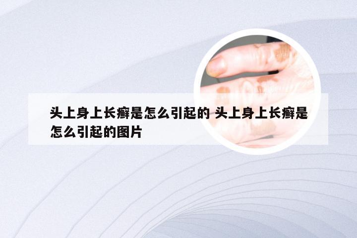 头上身上长癣是怎么引起的 头上身上长癣是怎么引起的图片