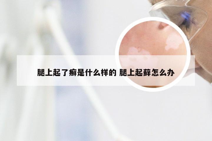 腿上起了癣是什么样的 腿上起藓怎么办