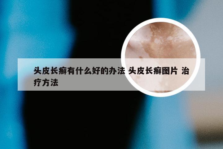 头皮长癣有什么好的办法 头皮长癣图片 治疗方法