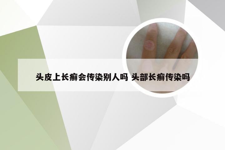 头皮上长癣会传染别人吗 头部长癣传染吗