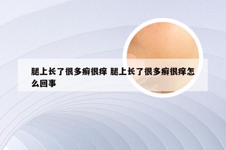 腿上长了很多癣很痒 腿上长了很多癣很痒怎么回事