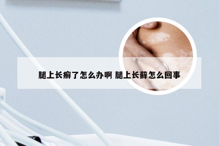 腿上长癣了怎么办啊 腿上长藓怎么回事