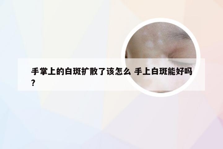 手掌上的白斑扩散了该怎么 手上白斑能好吗?