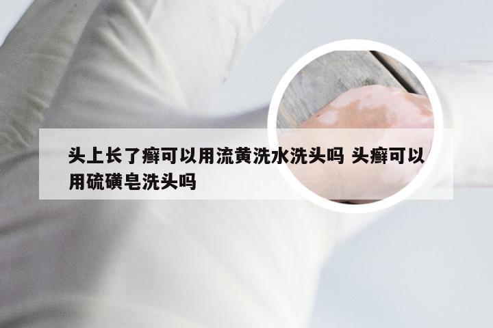 头上长了癣可以用流黄洗水洗头吗 头癣可以用硫磺皂洗头吗