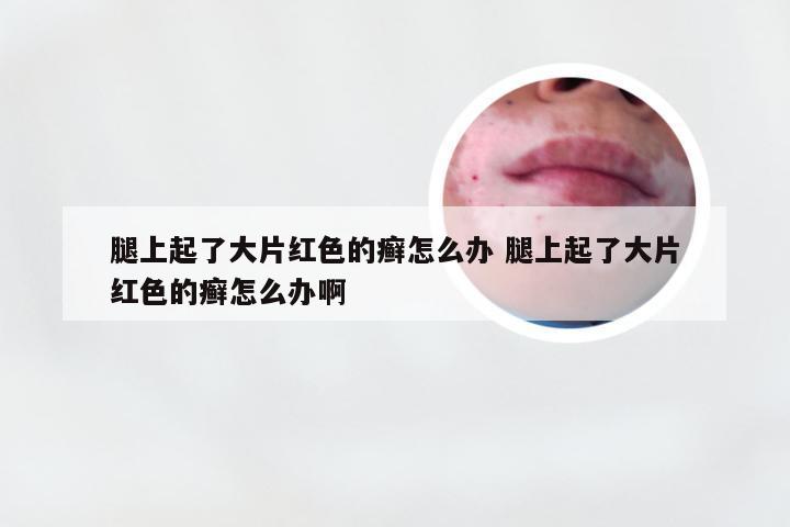 腿上起了大片红色的癣怎么办 腿上起了大片红色的癣怎么办啊