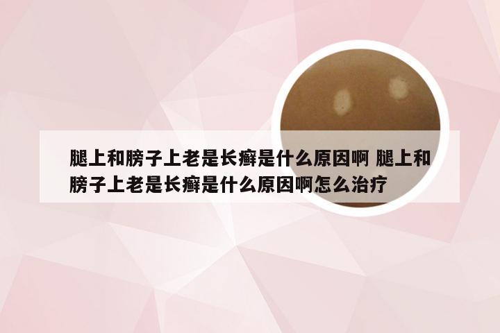 腿上和膀子上老是长癣是什么原因啊 腿上和膀子上老是长癣是什么原因啊怎么治疗