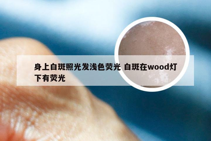 身上白斑照光发浅色荧光 白斑在wood灯下有荧光