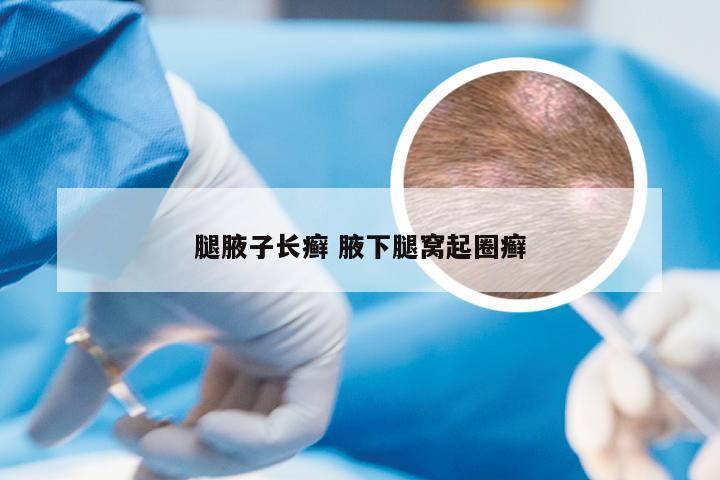 腿腋子长癣 腋下腿窝起圈癣