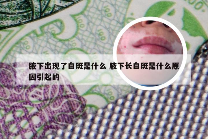 腋下出现了白斑是什么 腋下长白斑是什么原因引起的