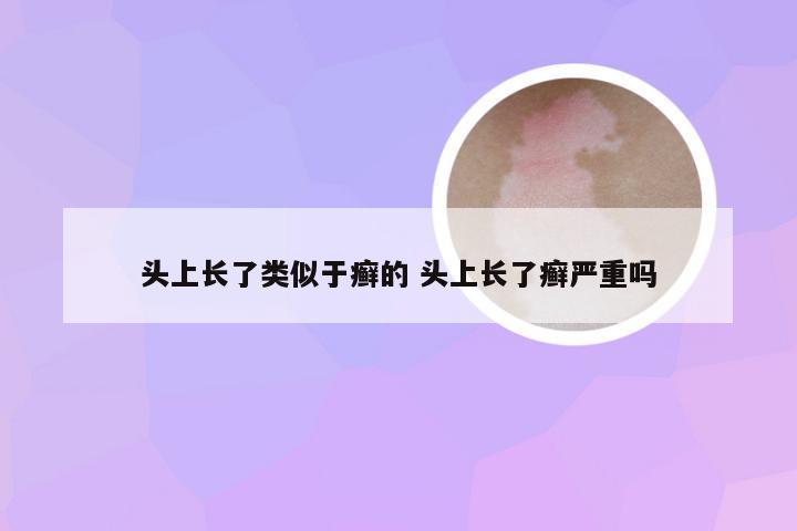 头上长了类似于癣的 头上长了癣严重吗