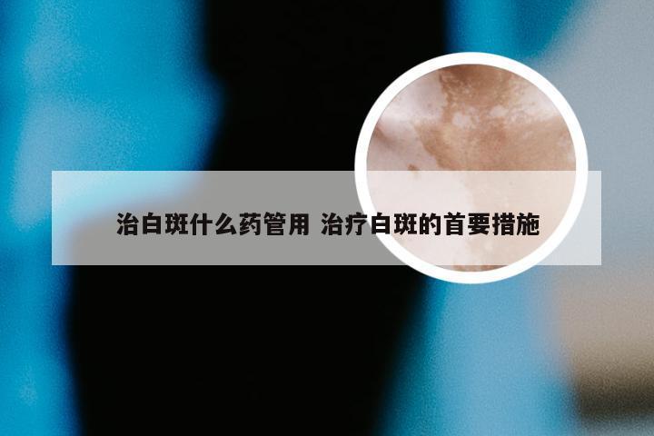 治白斑什么药管用 治疗白斑的首要措施