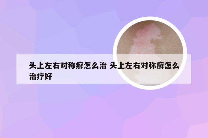 头上左右对称癣怎么治 头上左右对称癣怎么治疗好