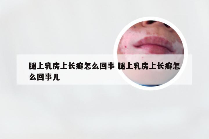 腿上乳房上长癣怎么回事 腿上乳房上长癣怎么回事儿