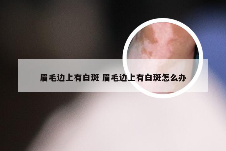 眉毛边上有白斑 眉毛边上有白斑怎么办