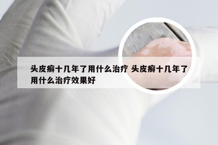 头皮癣十几年了用什么治疗 头皮癣十几年了用什么治疗效果好