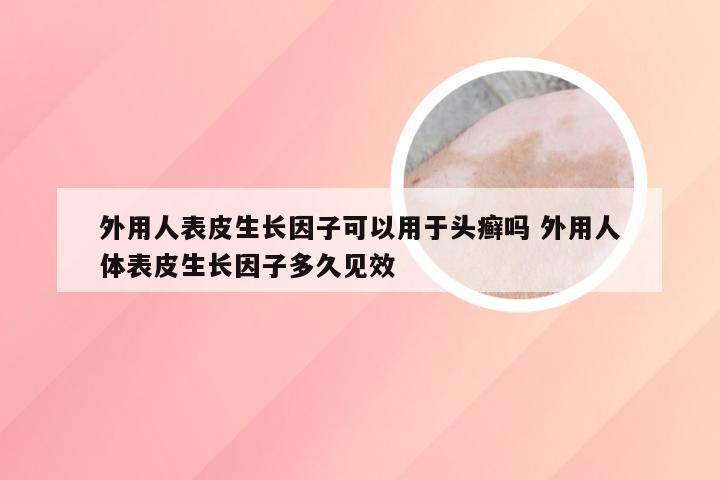 外用人表皮生长因子可以用于头癣吗 外用人体表皮生长因子多久见效