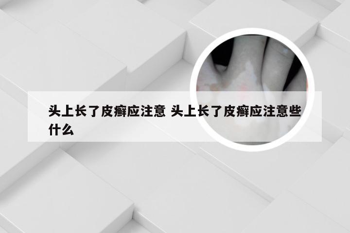 头上长了皮癣应注意 头上长了皮癣应注意些什么