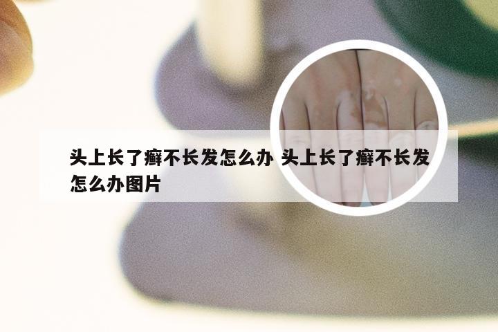 头上长了癣不长发怎么办 头上长了癣不长发怎么办图片