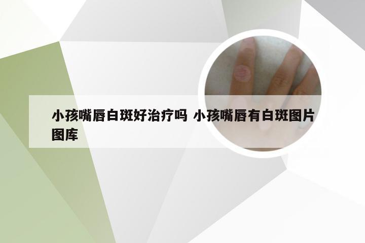 小孩嘴唇白斑好治疗吗 小孩嘴唇有白斑图片图库