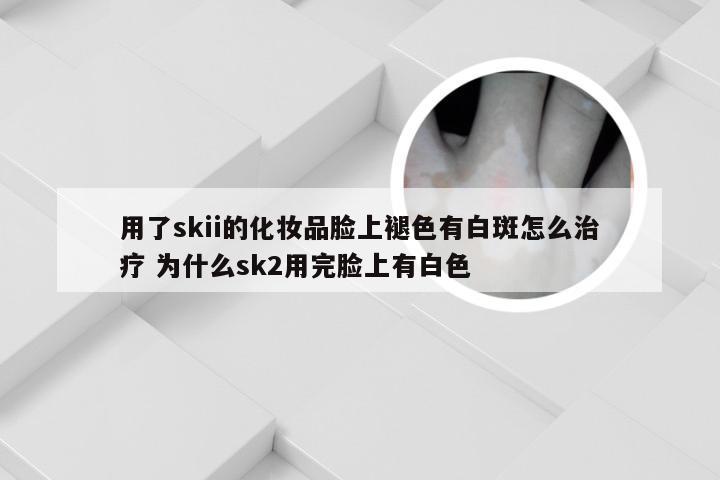 用了skii的化妆品脸上褪色有白斑怎么治疗 为什么sk2用完脸上有白色