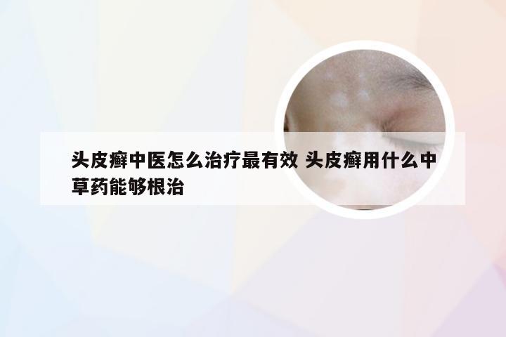 头皮癣中医怎么治疗最有效 头皮癣用什么中草药能够根治