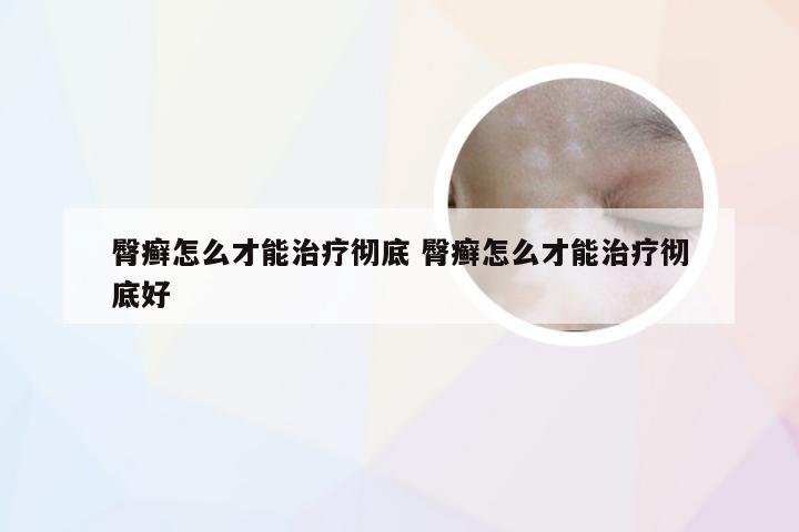 臀癣怎么才能治疗彻底 臀癣怎么才能治疗彻底好