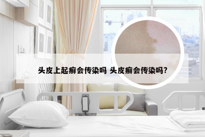 头皮上起癣会传染吗 头皮癣会传染吗?