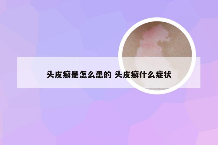 头皮癣是怎么患的 头皮癣什么症状