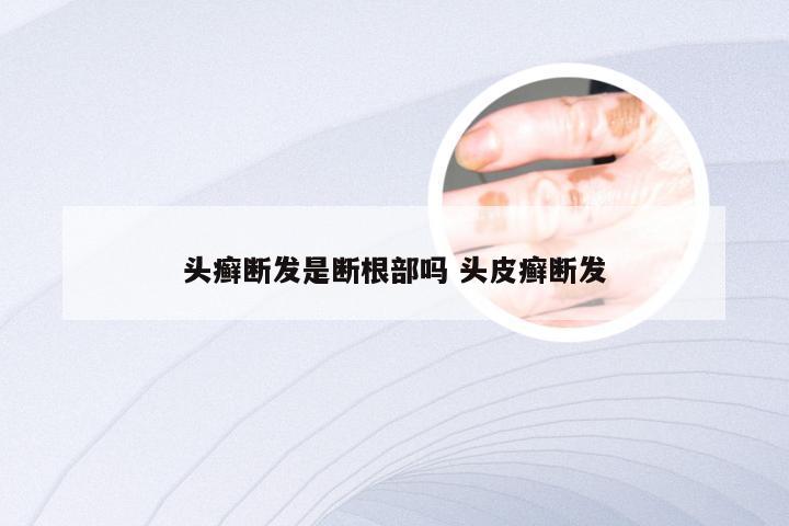 头癣断发是断根部吗 头皮癣断发