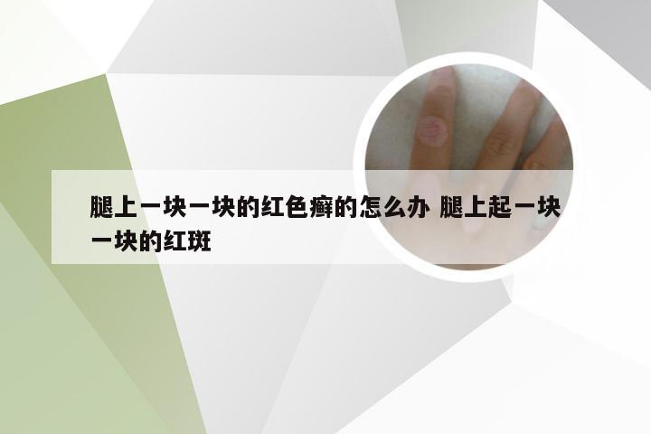 腿上一块一块的红色癣的怎么办 腿上起一块一块的红斑