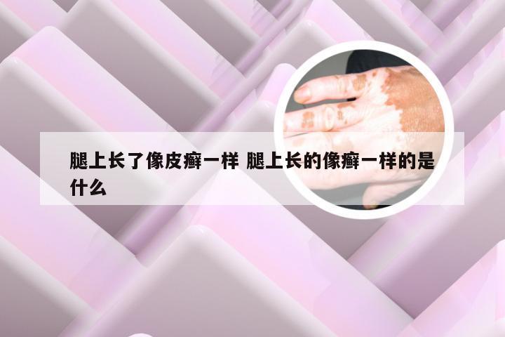 腿上长了像皮癣一样 腿上长的像癣一样的是什么