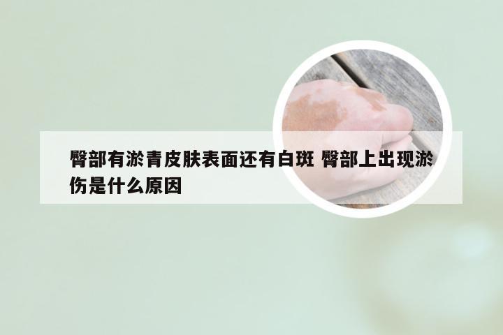 臀部有淤青皮肤表面还有白斑 臀部上出现淤伤是什么原因