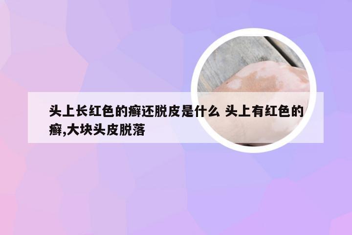 头上长红色的癣还脱皮是什么 头上有红色的癣,大块头皮脱落