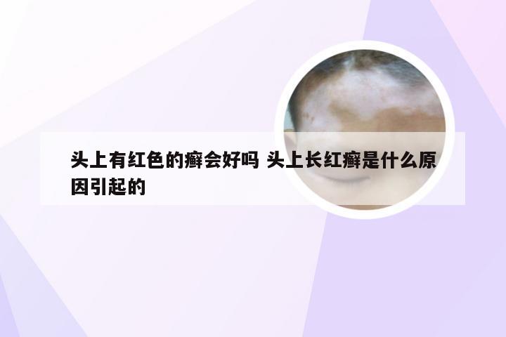 头上有红色的癣会好吗 头上长红癣是什么原因引起的