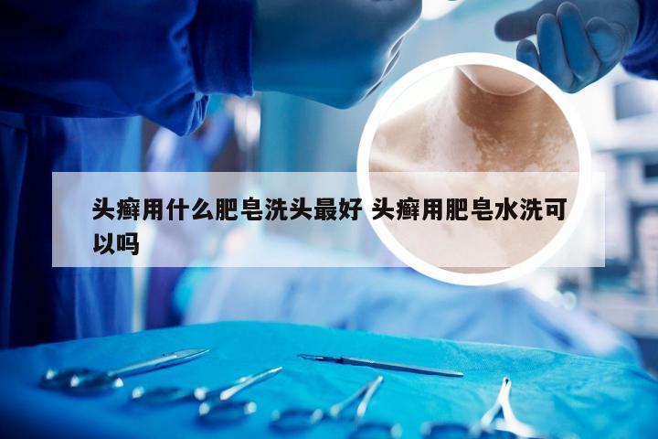 头癣用什么肥皂洗头最好 头癣用肥皂水洗可以吗