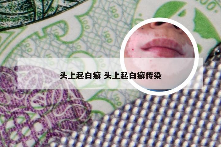 头上起白癣 头上起白癣传染