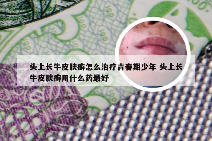 头上长牛皮肤癣怎么治疗青春期少年 头上长牛皮肤癣用什么药最好